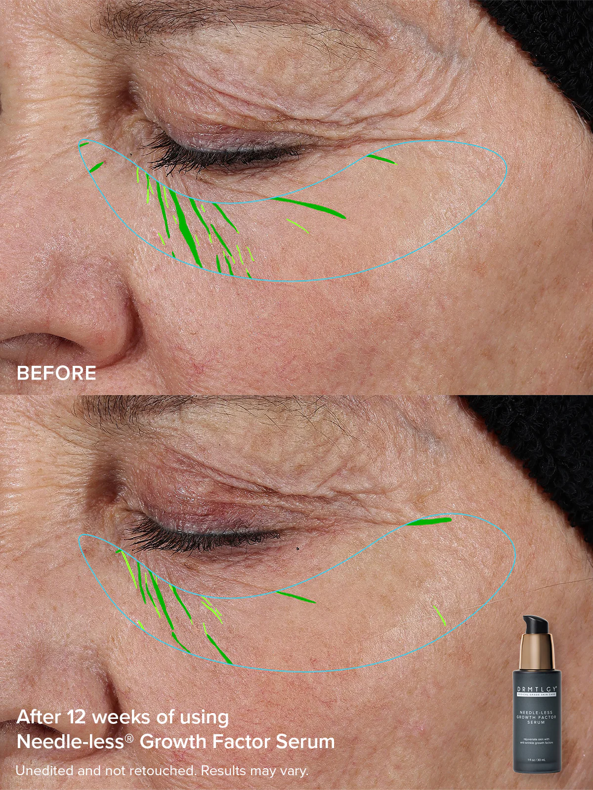 The Needle-less® Duo - Image 5